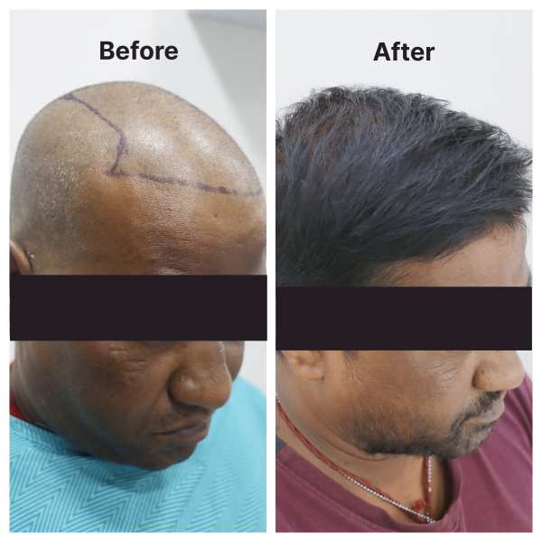 Hair Transplant result KOQ10